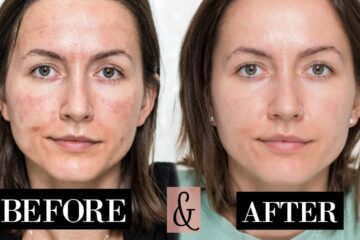 How to Care for Your Skin Before and After Microneedling