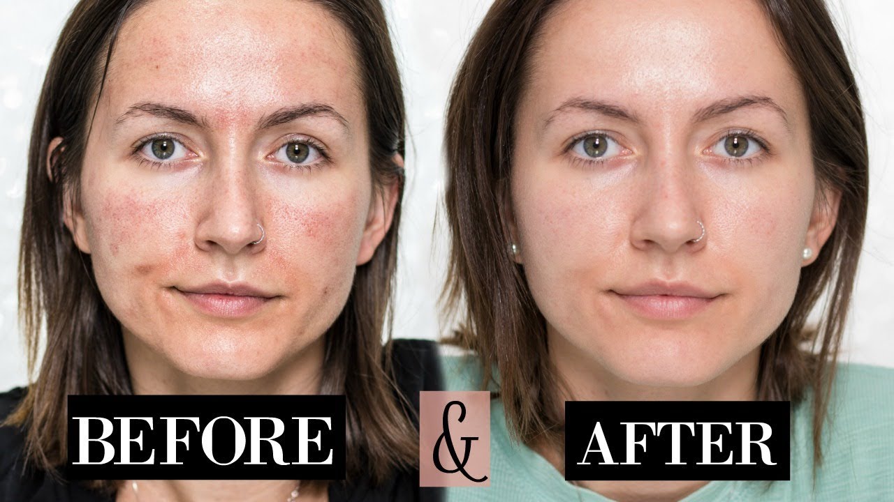 How to Care for Your Skin Before and After Microneedling